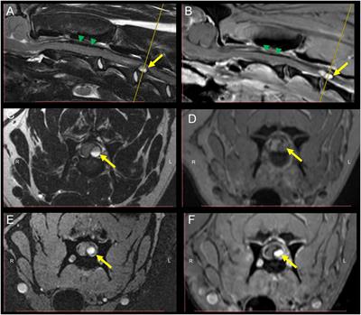 MRI Findings of Early-Stage Hyperacute Hemorrhage Causing Extramedullary Compression of the Cervical Spinal Cord in a Dog with Suspected Steroid-Responsive Meningitis-Arteritis